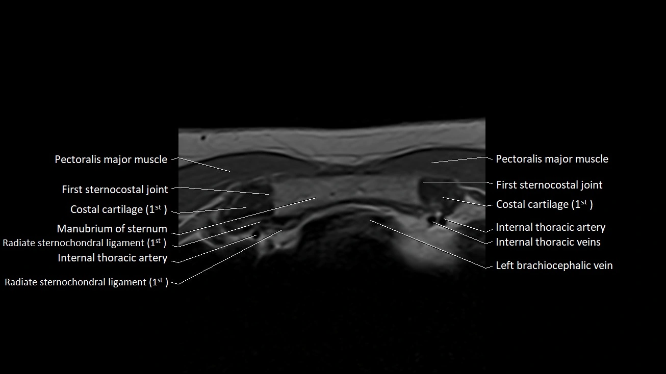 MRI sternum and sternoclavicular joint labeled axial anatomy image 8.webp